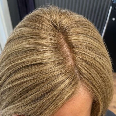 Na Alopecia Androgenetica