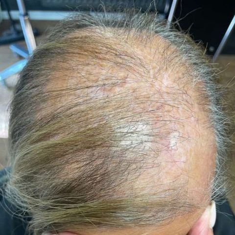 Voor Alopecia Androgenetica